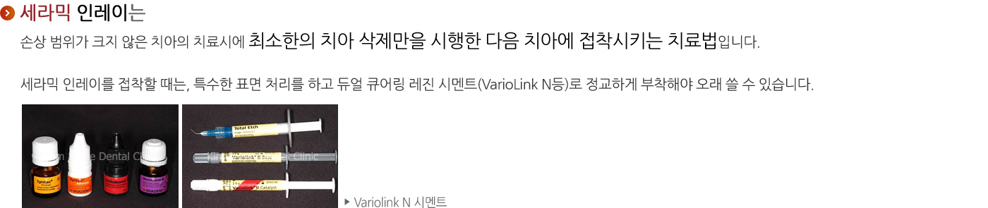 세라믹 인레이