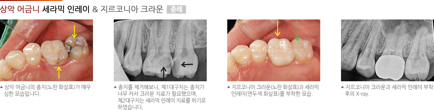 상악 어금니 세라믹 인레이 & 지르코니아 크라운