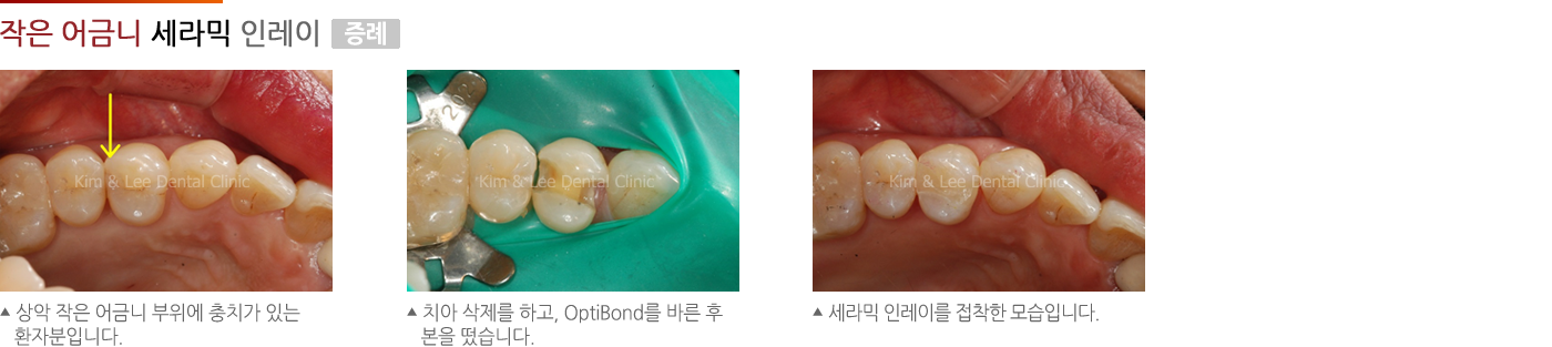 작은 어금니의 세라믹 인레이