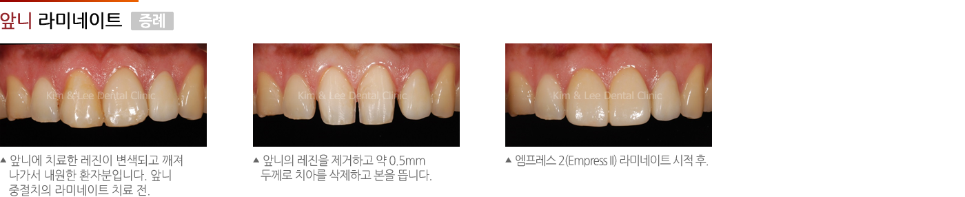 앞니 라미네이트