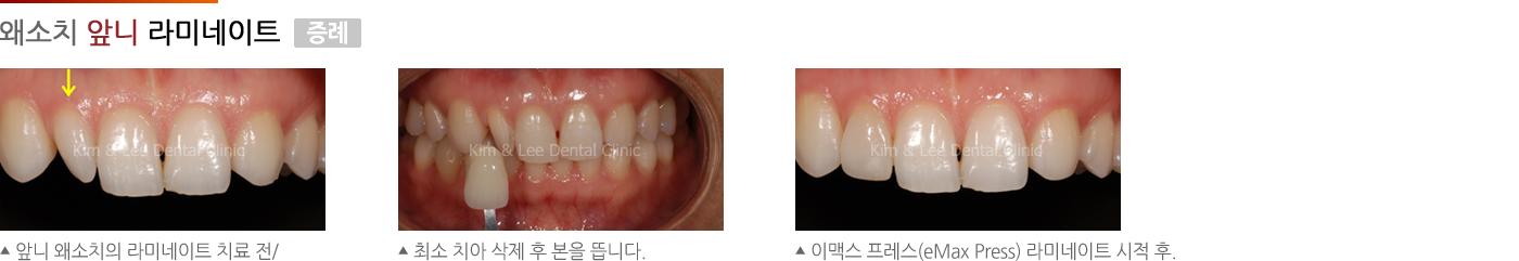 왜소치 앞니 라미네이트