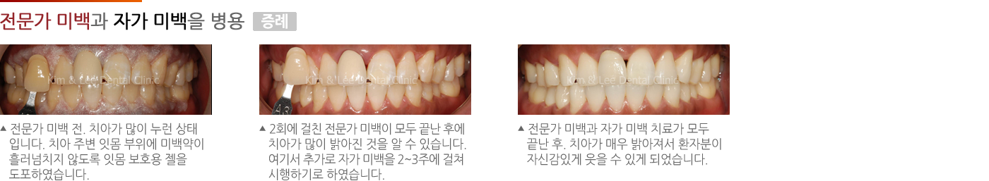 전문가 미백과 자가 미백을 병용한 증례