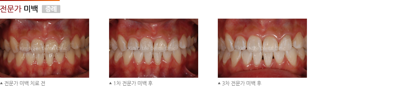 전문가 미백 증례