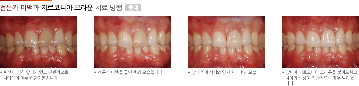 전문가 미백과 지르코니아 크라운 치료 병용 증례