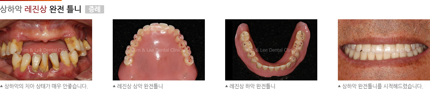 상하악 레진상 완전 틀니
