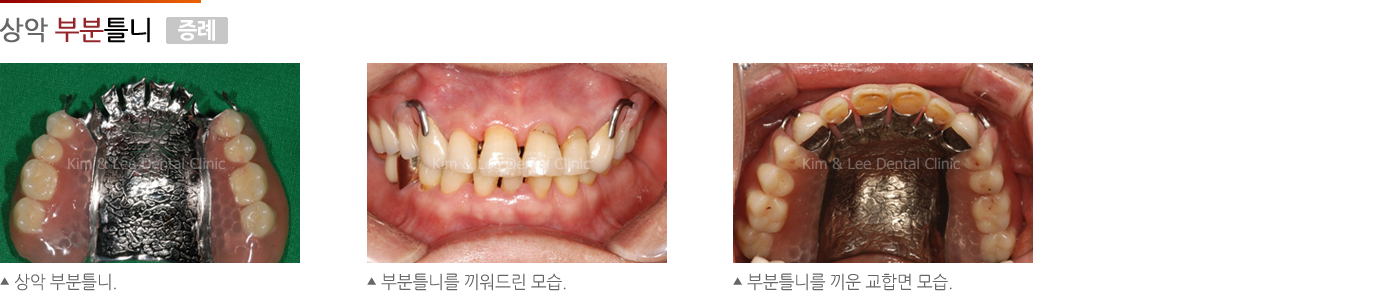 상악 부분틀니