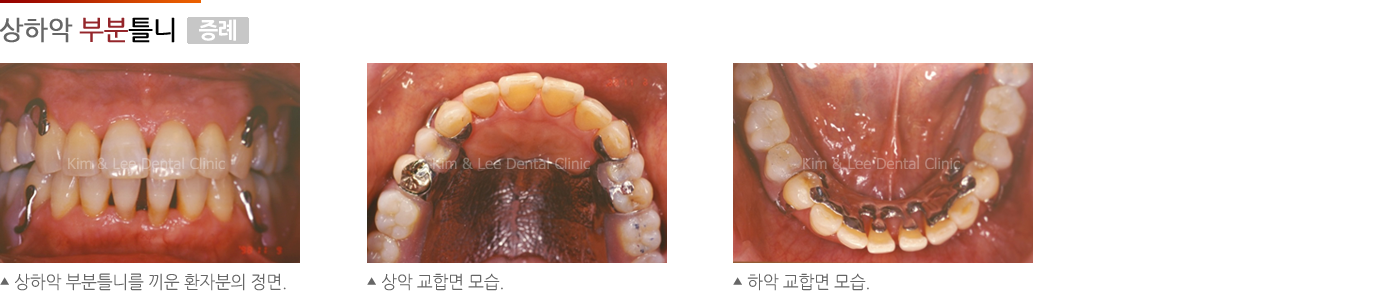 상하악 부분틀니