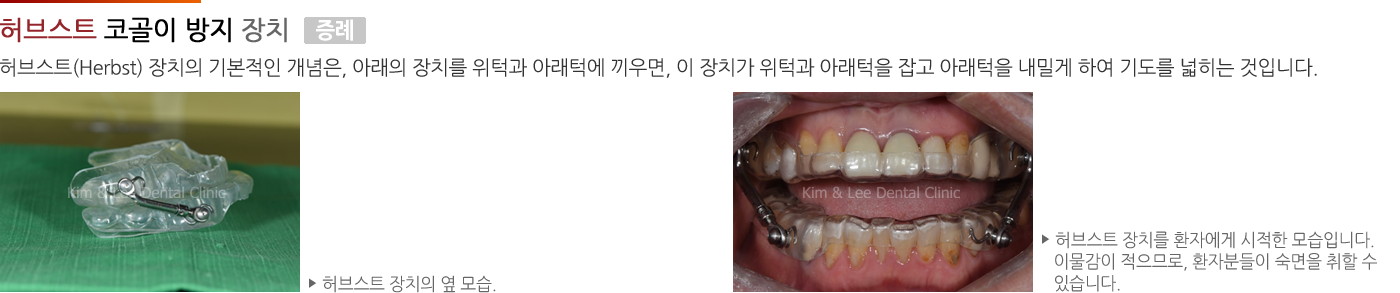 허브스트(Herbst) 코골이 방지 장치