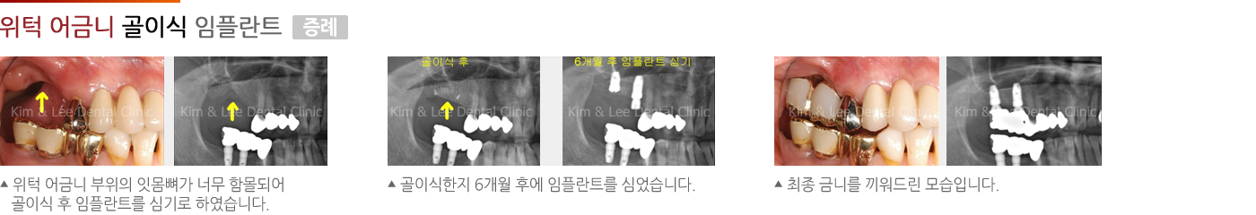 위턱 어금니 골이식 임플란트 증례
