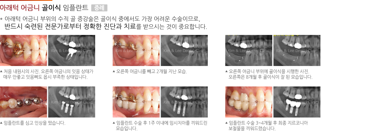 아래턱 어금니 골이식 임플란트 증례