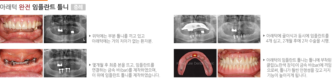 아래턱 완전 임플란트 틀니