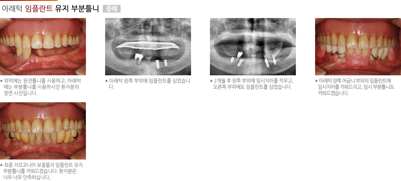 아래턱 임플란트 유지 부분틀니