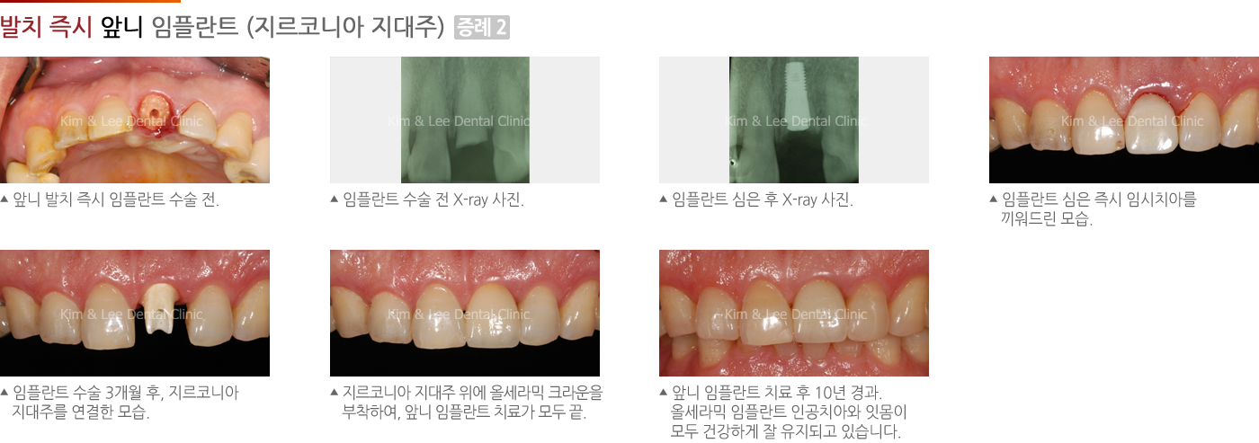 발치 즉시 앞니 임플란트 (지르코니아 지대주)