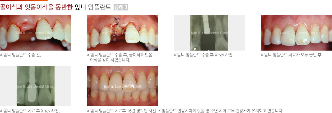 골이식과 잇몸이식을 동반한 앞니 임플란트