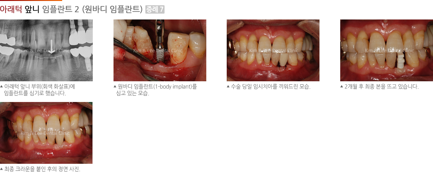 아래턱 앞니 임플란트 2 (원바디 임플란트)