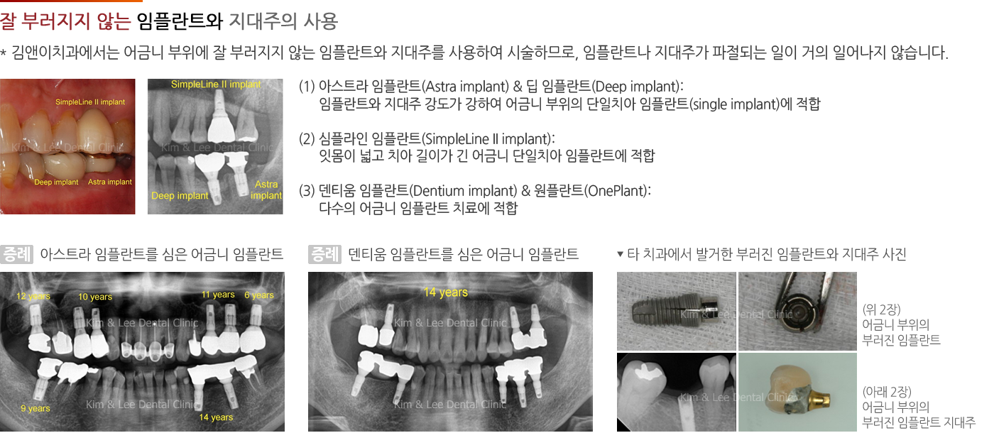 잘 부러지지 않는 임플란트와 지대주의 사용