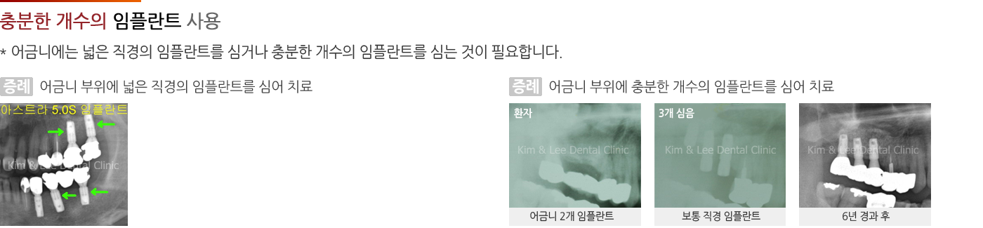 잘 부러지지 않는 임플란트와 지대주의 사용