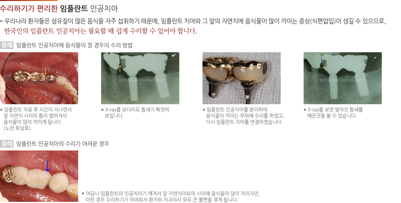 수리하기가 편리한 임플란트 인공치아