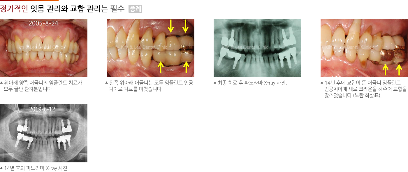 정기적인 잇몸 관리와 교합 관리는 필수