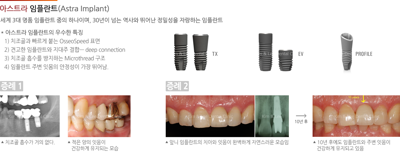 아스트라 임플란트 (Astra Implant)