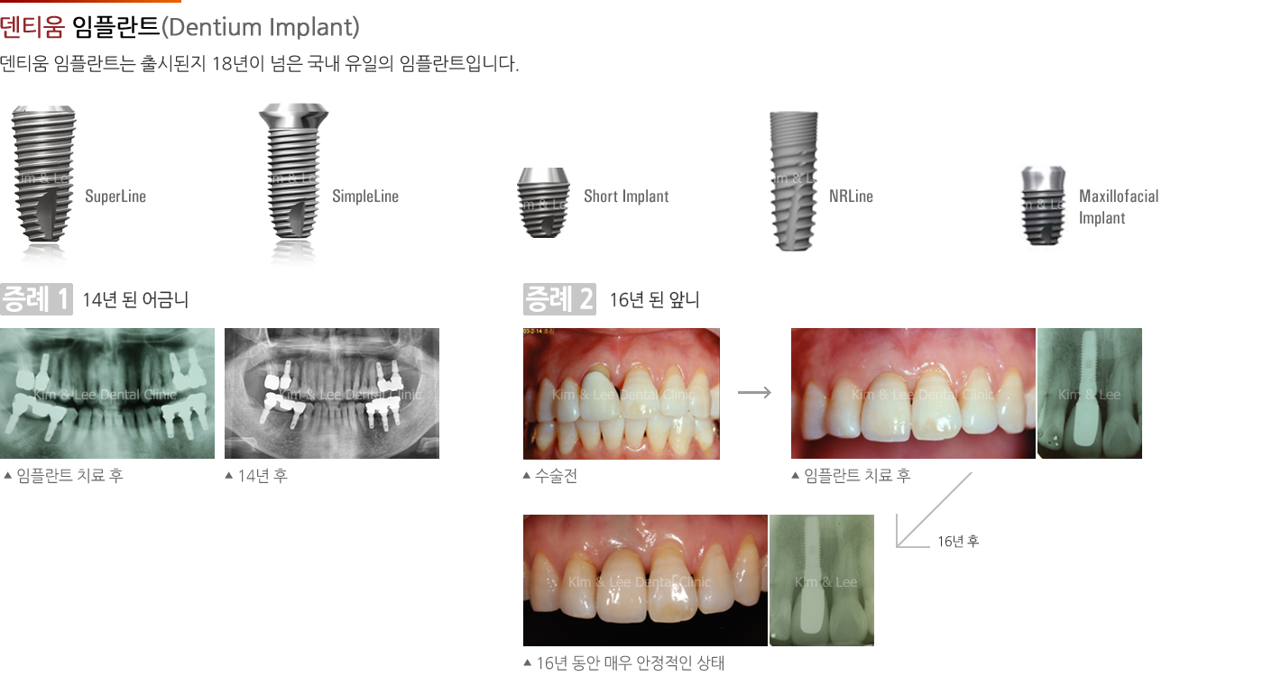덴티움 임플란트 (Dentium Implant)