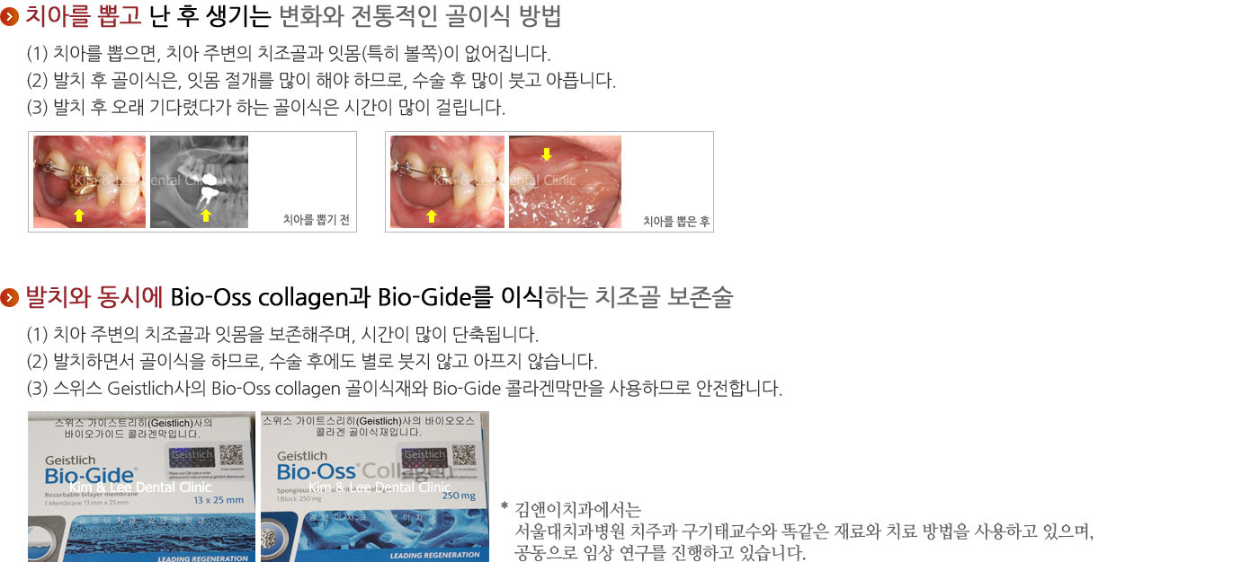 발치와(치조골) 보존술