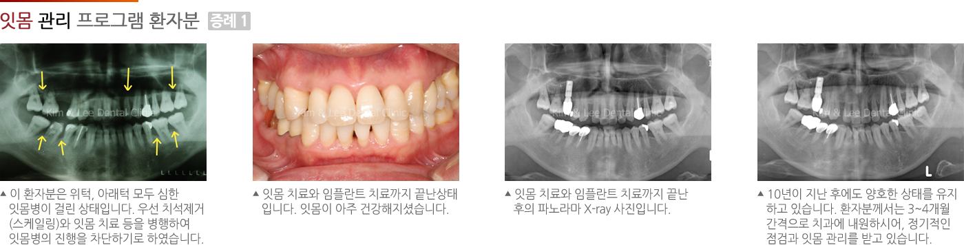 잇몸 관리 프로그램 환자분 증례 I