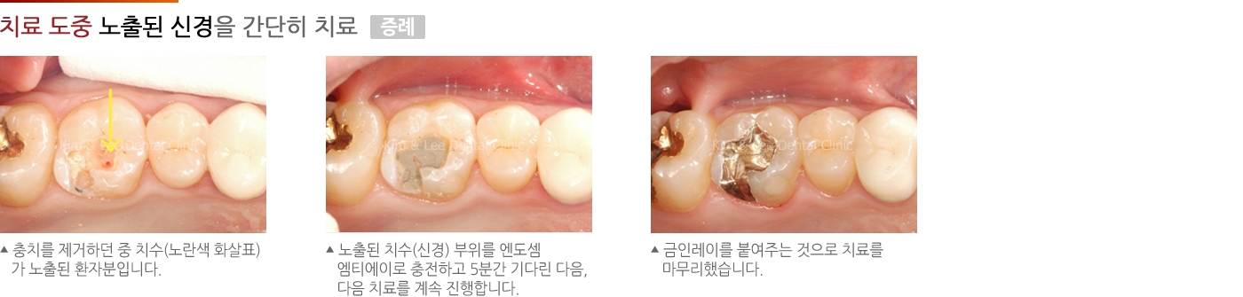 치료 도중 노출된 신경을 간단히 치료한 증례