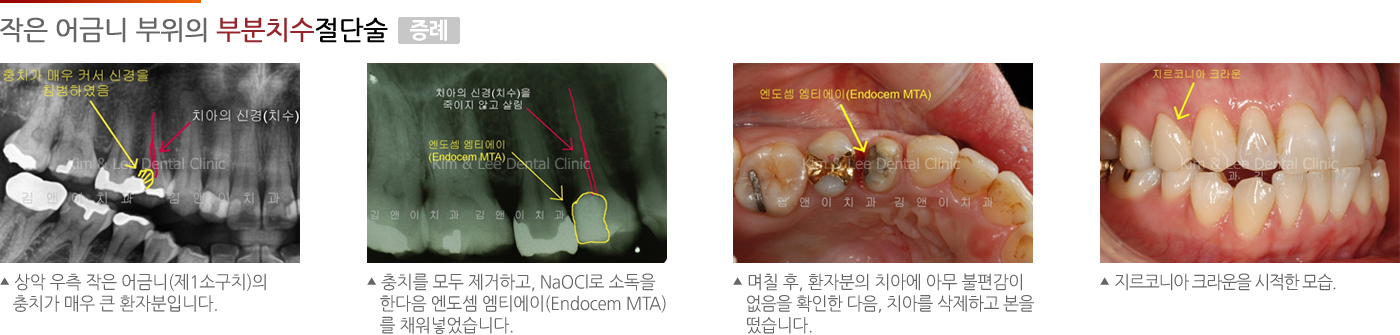 작은 어금니 부위의 부분치수절단술