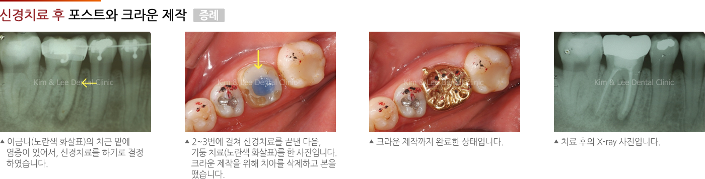 신경치료후 포스트와 크라운 제작 증례