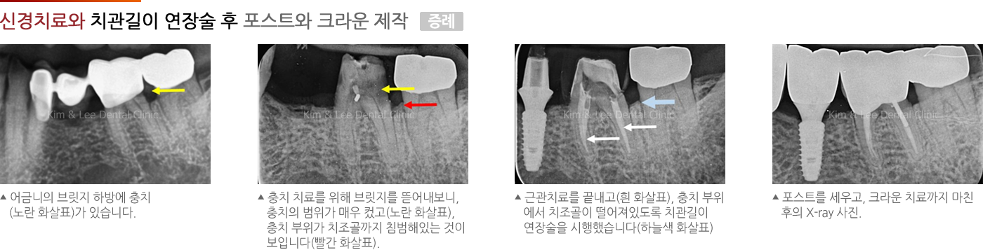 신경치료와 치관길이 연장술 후 포스트와 크라운 제작 증례