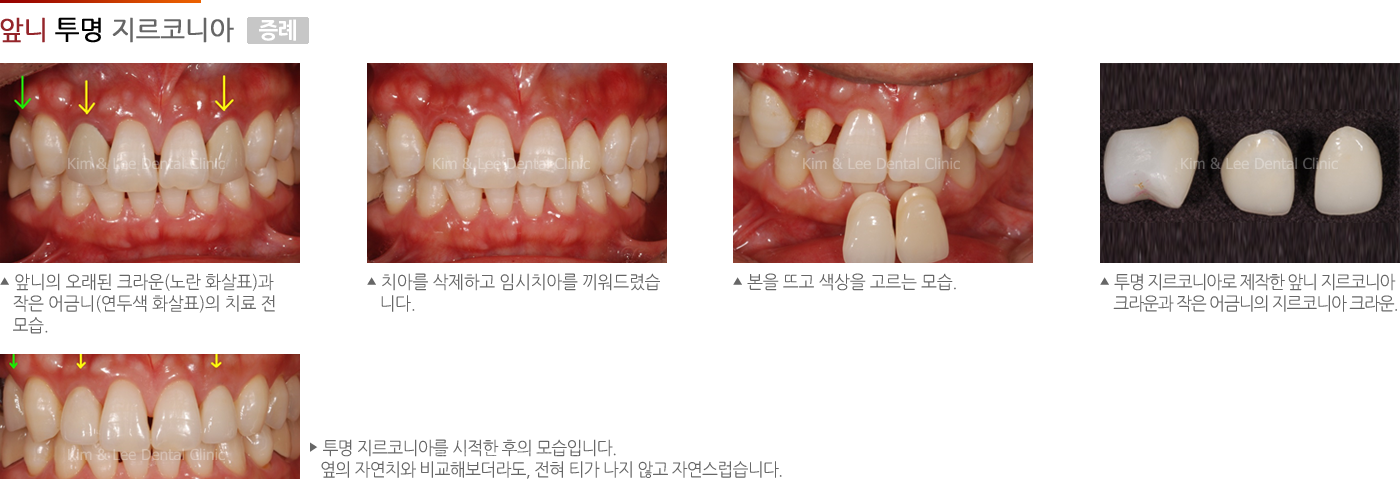 앞니 투명 지르코니아