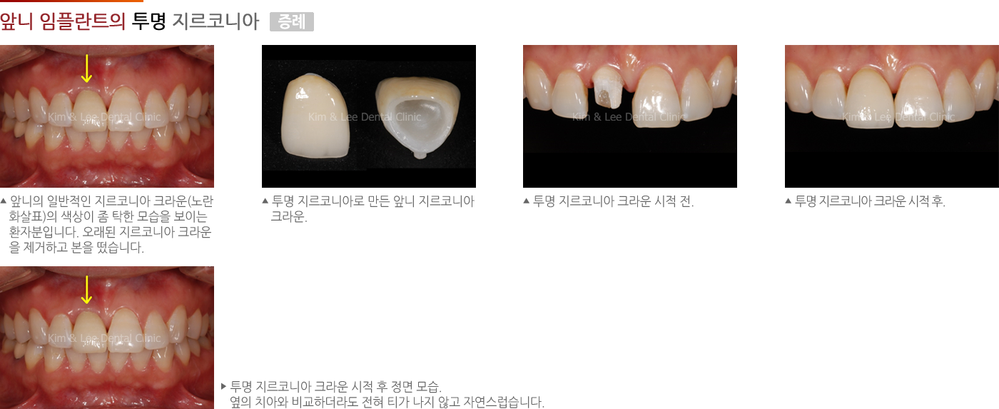 앞니 임플란트의 투명 지르코니아