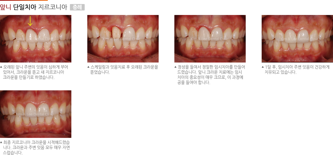 앞니 단일치아 지르코니아