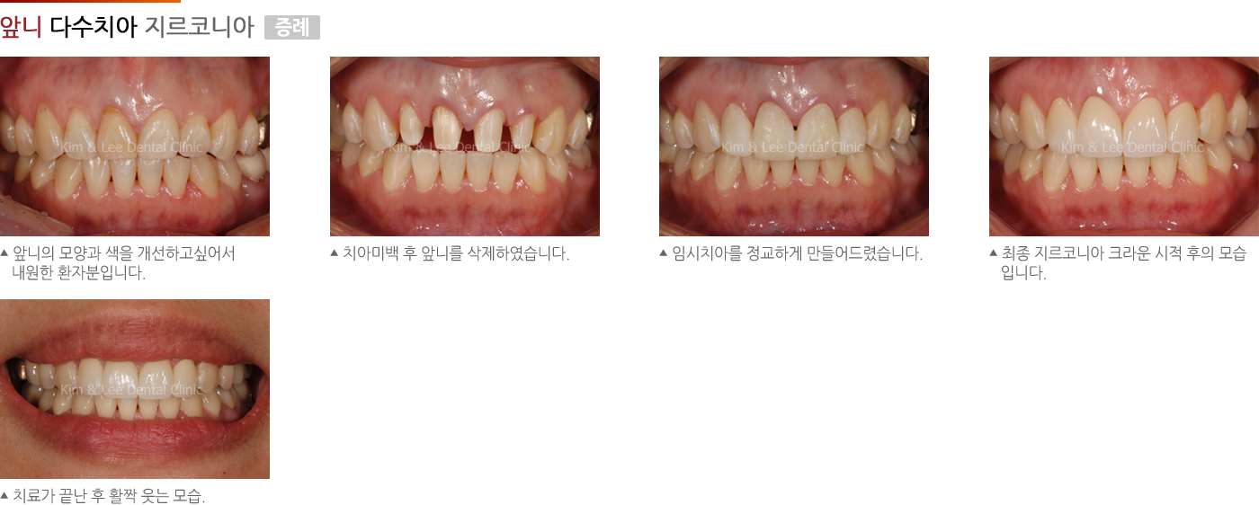 앞니 다수치아 지르코니아