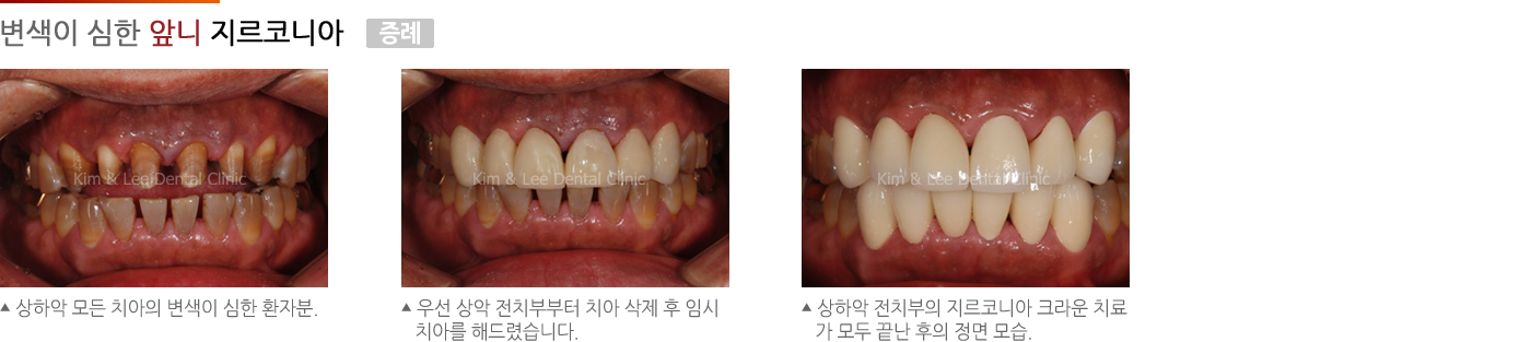 변색이 심한 앞니의 지르코니아
