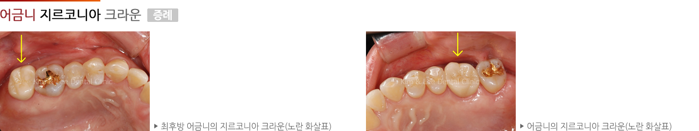 어금니 지르코니아 크라운 