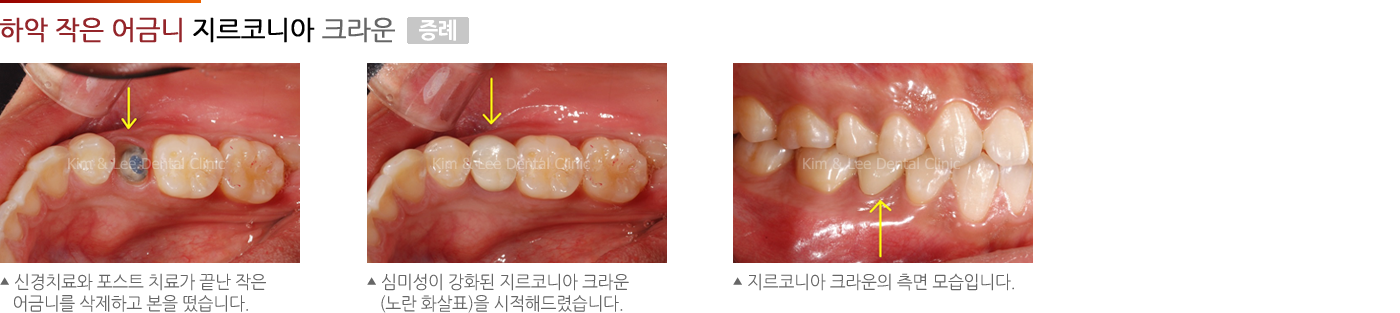 하악 작은 어금니 지르코니아 크라운