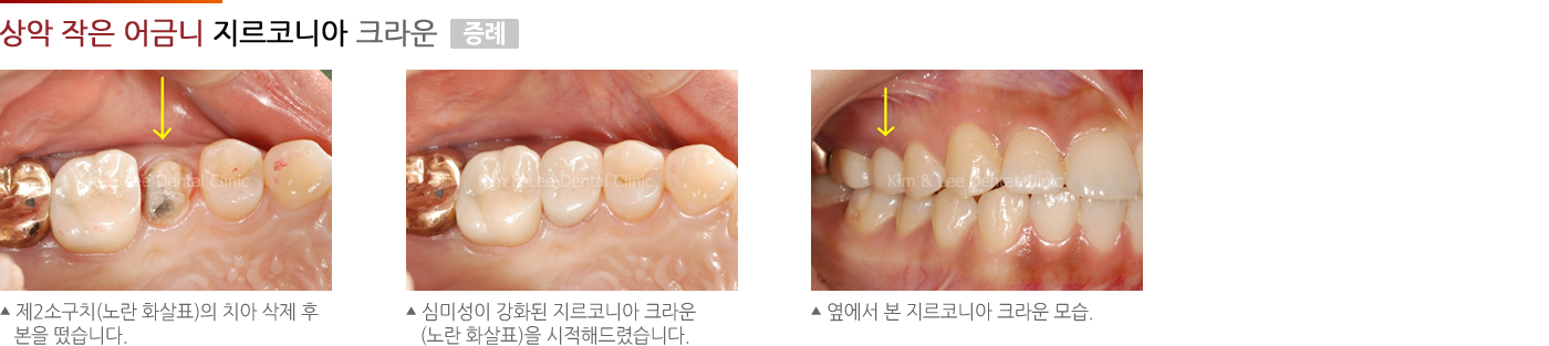 상악 작은 어금니 지르코니아 크라운